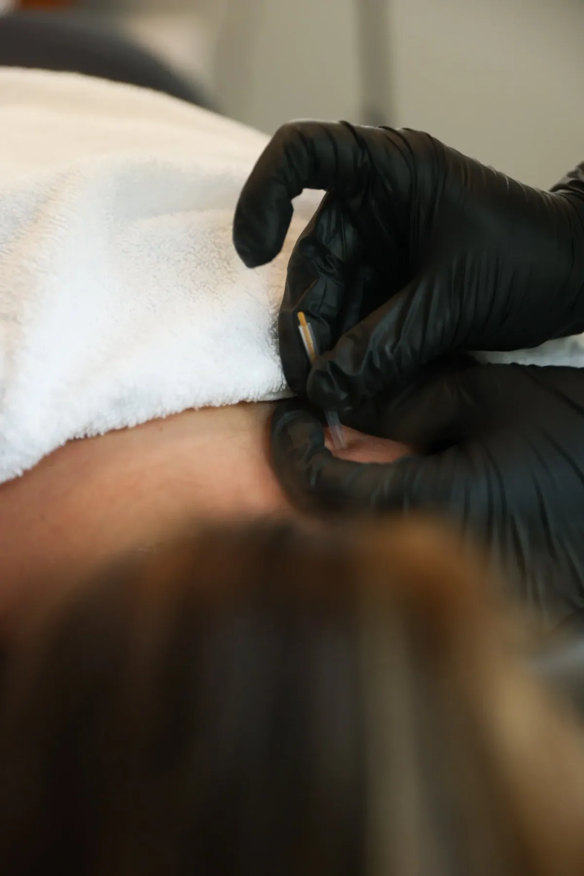 A close view of gloved hands as they insert a dry needle