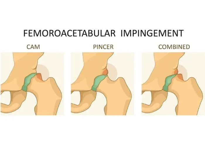 Diagram of femoroacetabular impingement at the hip: the cam type, the pincer type, and the combined type